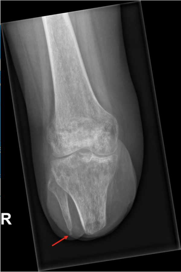 Fibula shortening