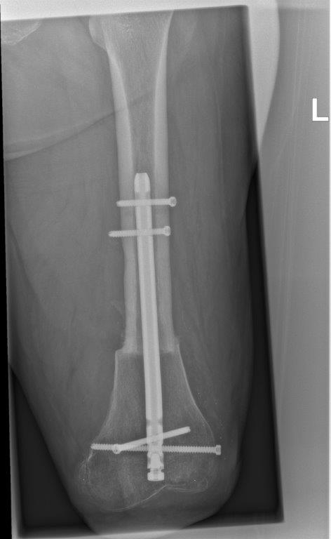 Inkorting na knie exarticulatie - Shortening after knee disarticulation