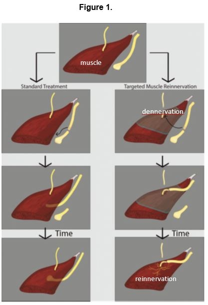 Targeted Muscle Reinnervation treatment