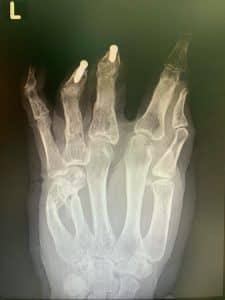 osseointegratie voor handen - Prosthesis fingers