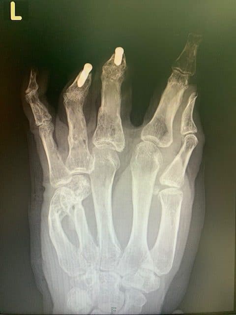 x-ray