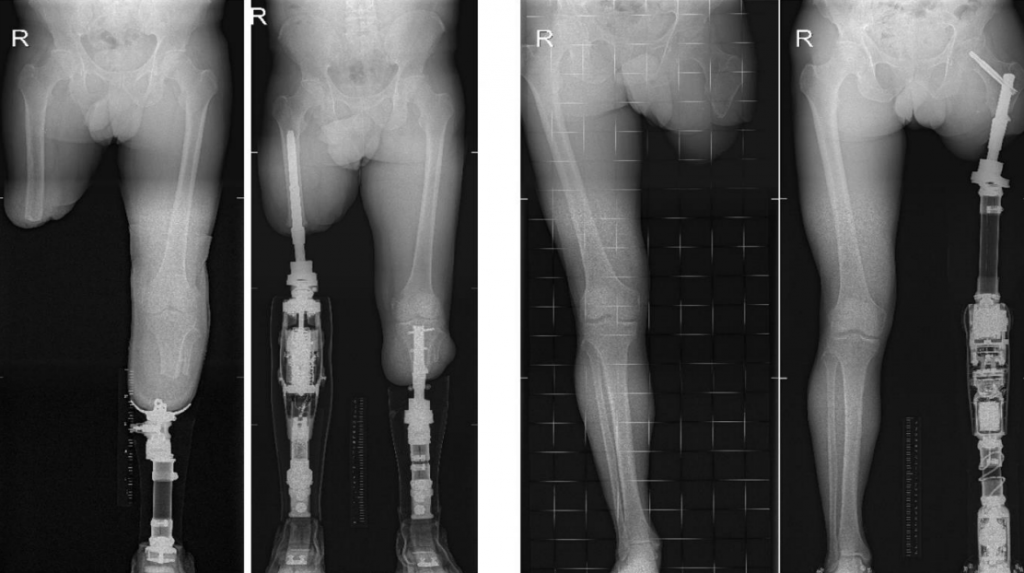 rontgenfoto osseointegratie - leg or arm amputation prosthesis treatment