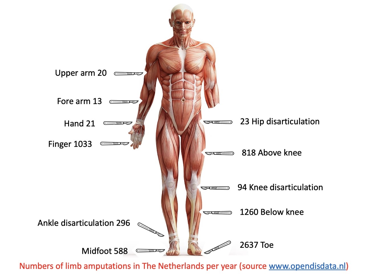 aantallen Primaire amputatie - numbers of primary limb amputations